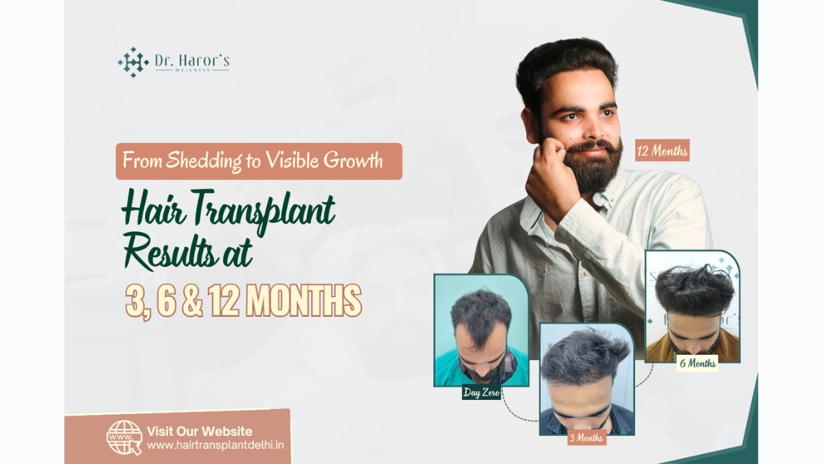 From Shedding to Visible Growth: Hair Transplant Results at 3, 6 and 12 Months